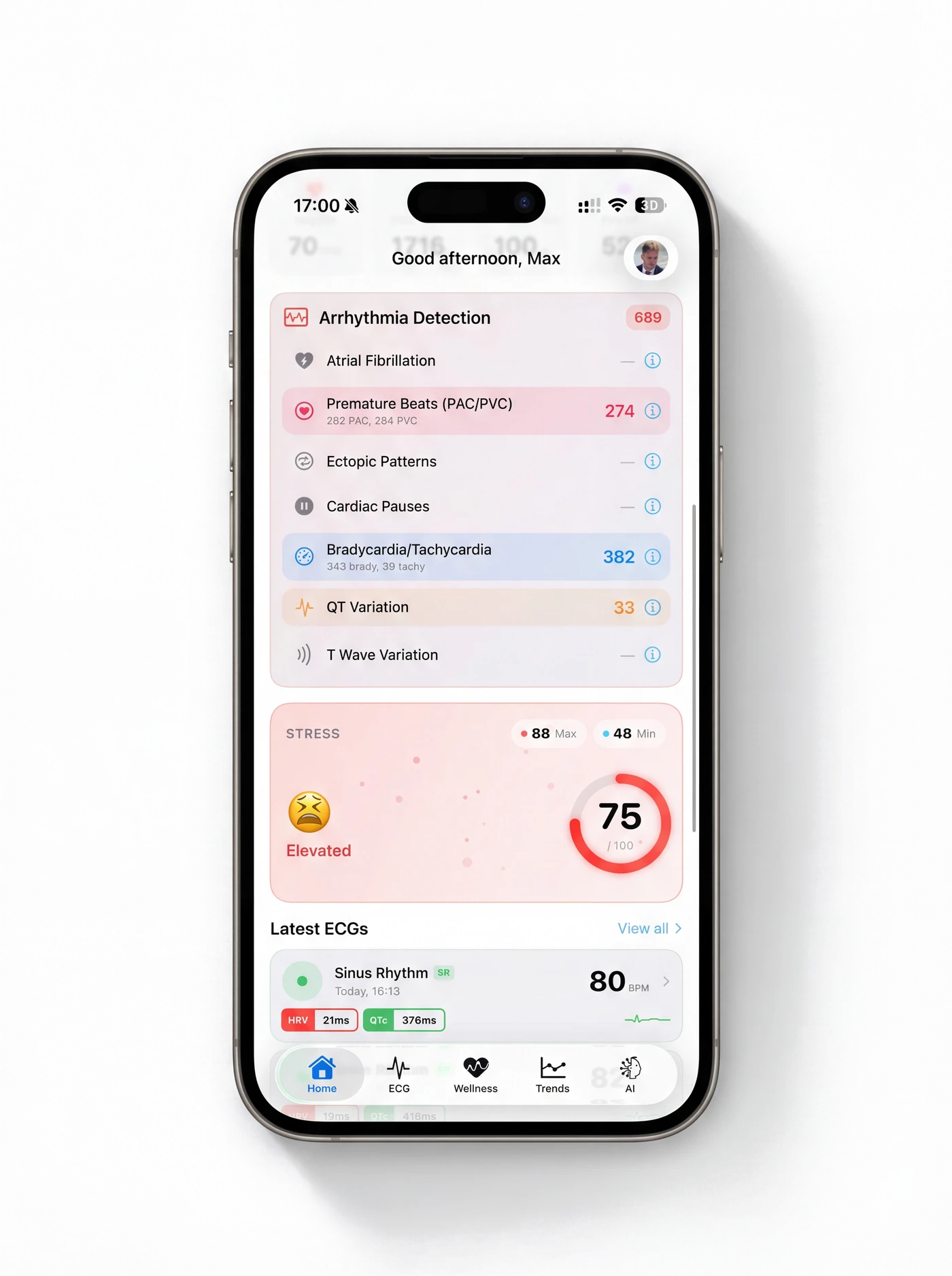 Deteccion de arritmias en HeartLab