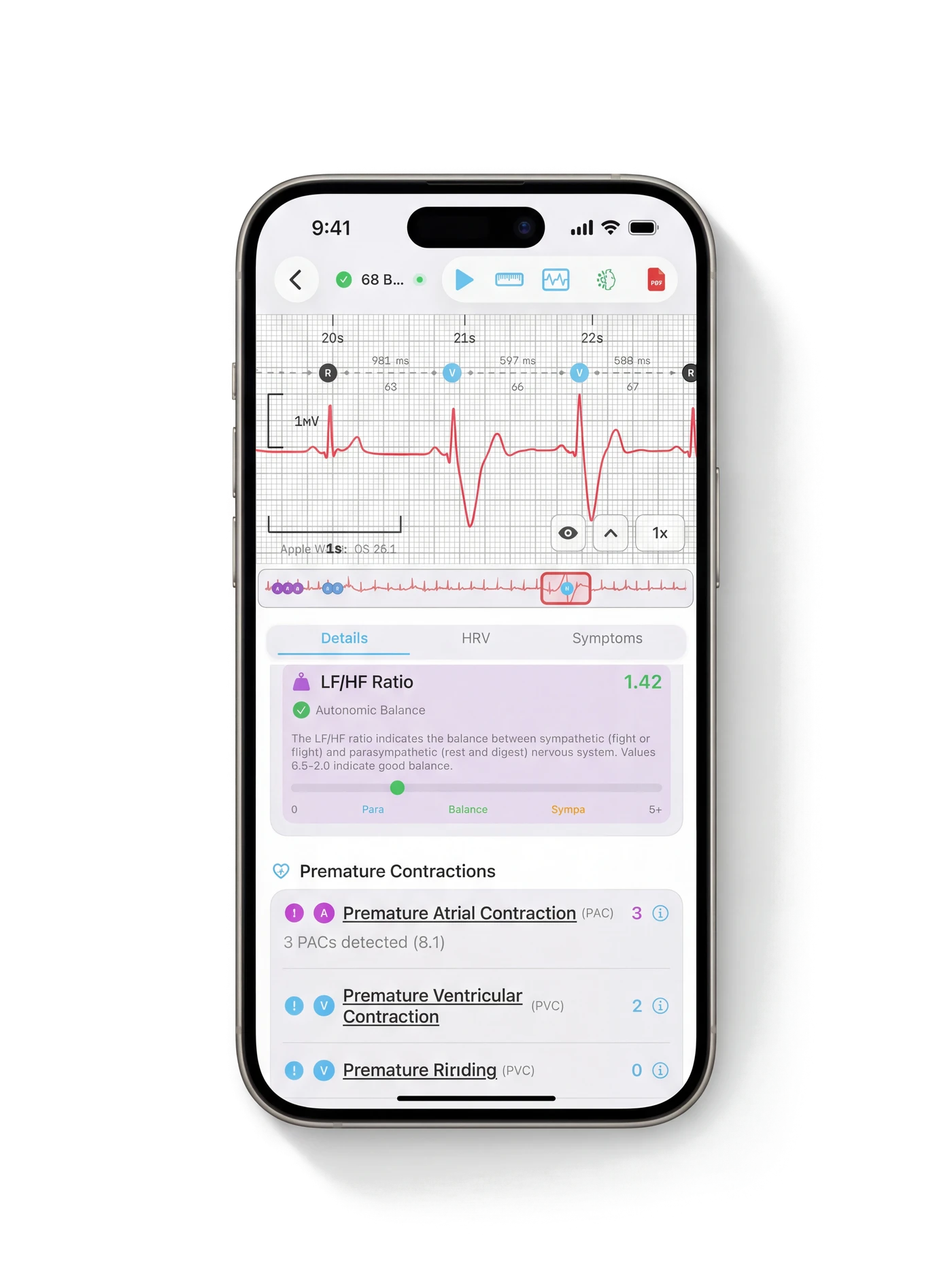 Analisis detallado de ECG en HeartLab